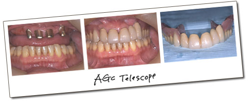 AGCテレスコープ義歯　イメージ写真